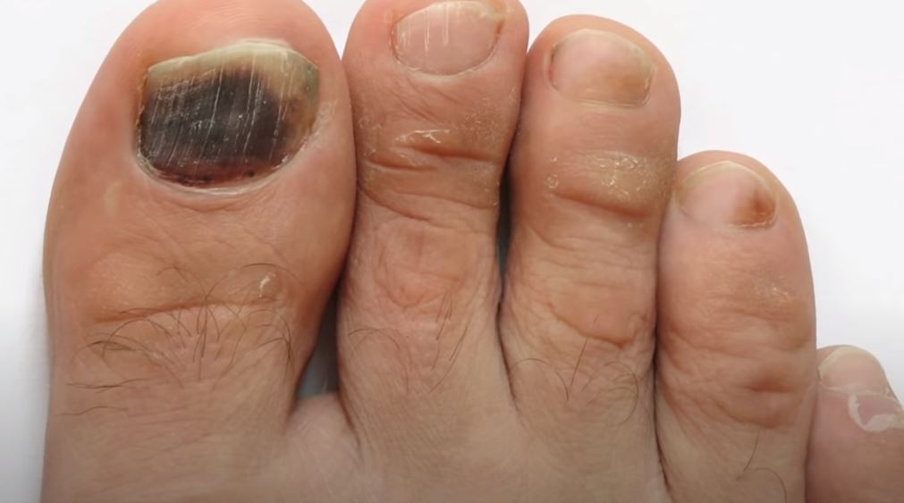 1. Fungal Nail Infection - wide 4