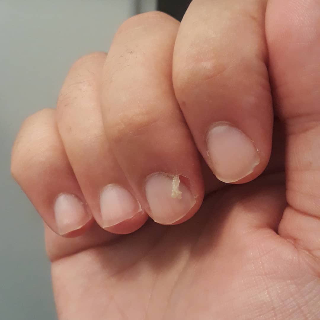 How To Fix A Hangnail  Using 4 Essential Steps Nail Care Hub