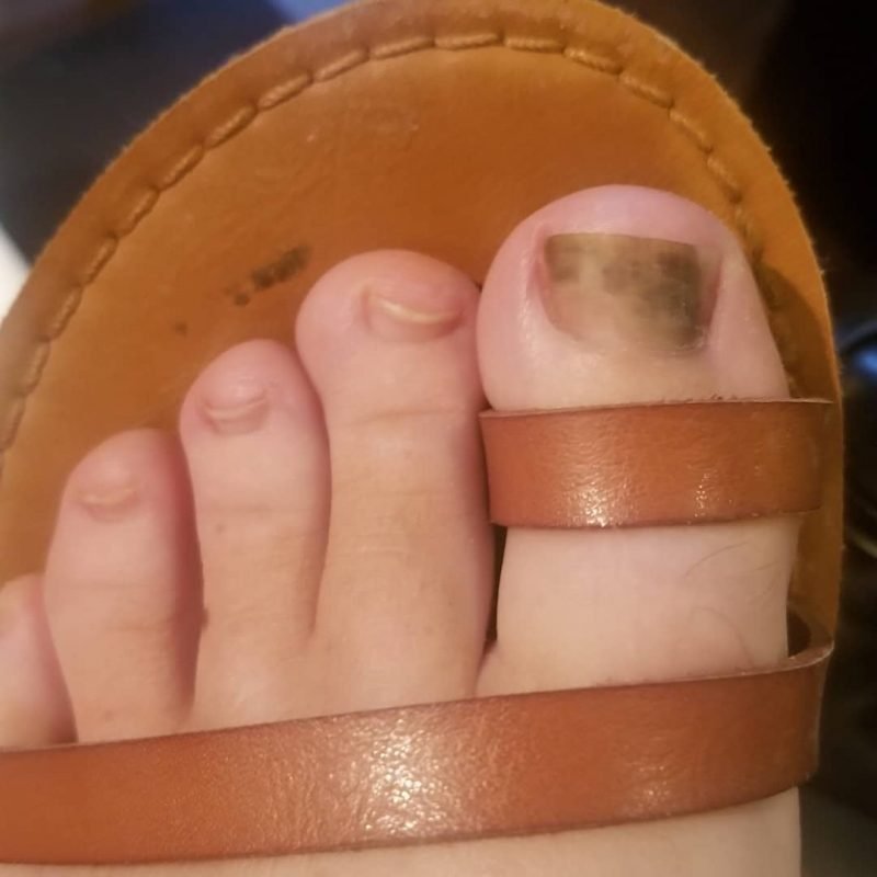 Toe Nail Fungus Infection