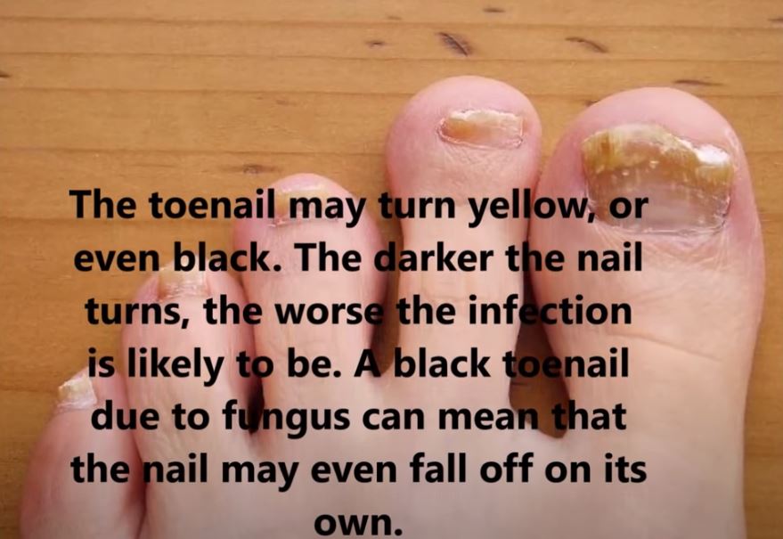 Signs of Toenail Fungus