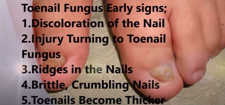 Signs of Toenail Fungus