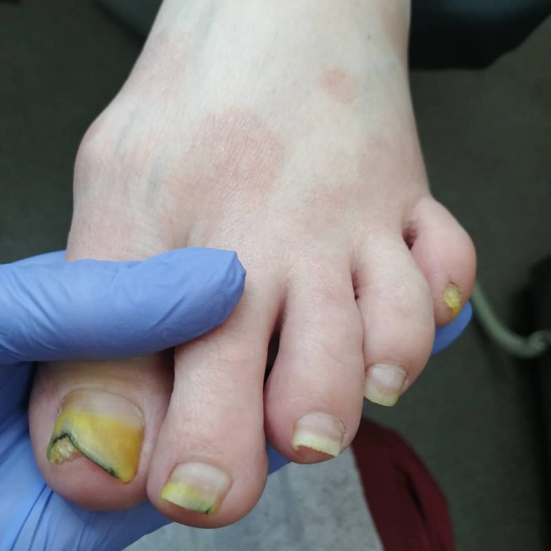 how do you know if you have nail fungus
